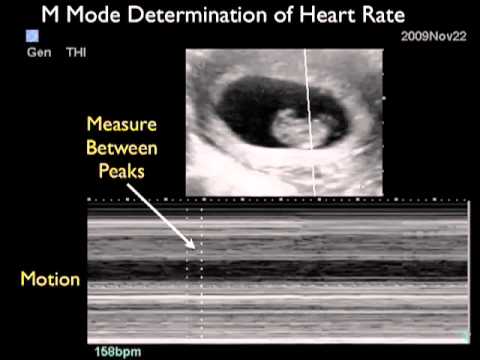 how to measure fetal heart rate in m-mode