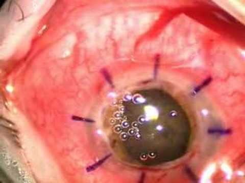 Cornea Transplant. Length: 9:18; Rating Average: 4.9' max='5' min='1' numRaters='40' rel='http://schemas.google.com/g/2005#overall from people; View Count: 