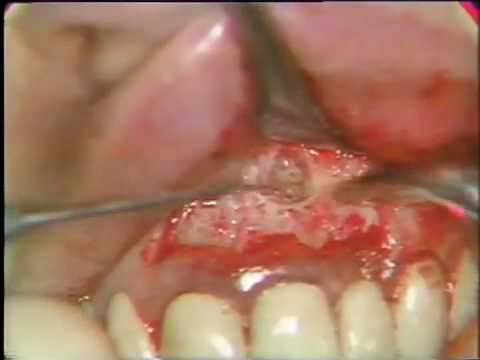 how to treat a periapical and a apex abscess on tooth