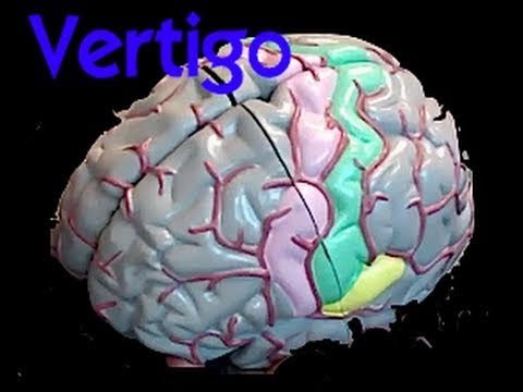 how to treat ms vertigo