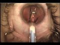 Implantable Collamer Lens Insertion Refractive Errors