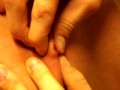 Grossest pimple in Australia
