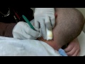 Cyst Removal