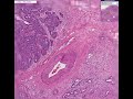 Histopathology Ovary--Adenocarcinoma