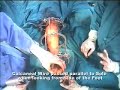 Lengthening over Nail, Gigli Saw osteotomy - Part 3