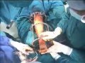 Lengthening over Nail, Gigli Saw osteotomy - Part 3
