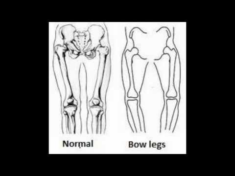 how to cure bow legs