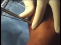 Operative Video - Fixator Assisted HTO - Part 1 Operative Video - Fixator Assisted HTO - Part 1