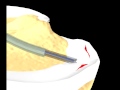 Click to View : Meniscal Repair - Patients Education