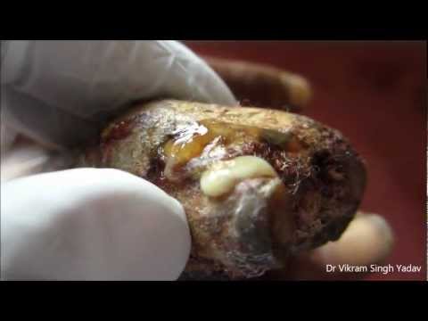 how to treat wound infection