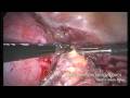 Part 2 of a narrated, full-length total laparoscopic hysterectomy and removal of both ovaries for fibroids and pelvic pain. A Ligasure device is used to seal the vessels. Laparoscopic suturing is performed to close the vaginal apex after the uterus and cervix are removed. The entire procedure took approximately 35 minutes and is shown in its entirety in Parts 1 - 4. The patient went home right after surgery and can return to work in about 2 weeks.