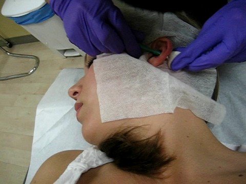 dermal punch 6 gauge conch. documented ear punch by Ruben Lew. dermal punch 6 gauge conch. documented ear punch by Ruben Lew.
