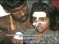 Encephalitis Encephalitis