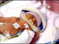 Encephalitis