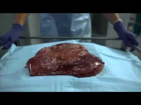 how to treat hepatitis b australian doctor