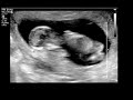 Gioiella - nella pancia a 13 settimane
