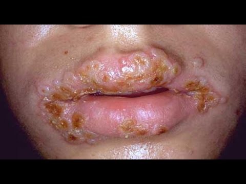 how to treat a cold sore with l-lysine