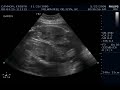 The-Twins-28-Week-Ul