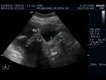 The-Twins-28-Week-Ul