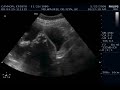 The-Twins-28-Week-Ul