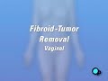 PreOp® Patient Education Myomectomy Vaginal Fibroid  Surgery