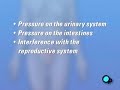 PreOp® Patient Education Myomectomy Vaginal Fibroid  Surgery