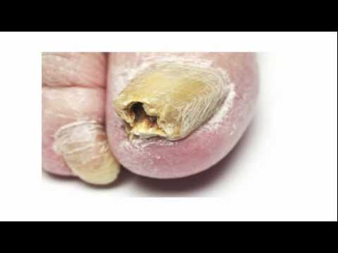 how to kill fingernail fungus