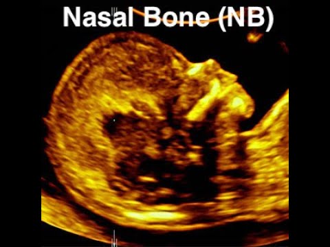 how to measure nt in ultrasound