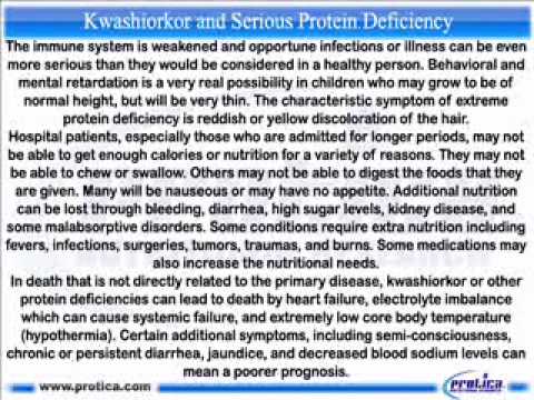 how to treat kwashiorkor