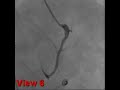 Heart (cardiac) catheterization