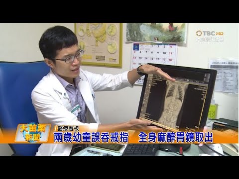 1090729大苗栗新聞 兩歲幼童誤吞戒指 全身麻醉胃鏡取出