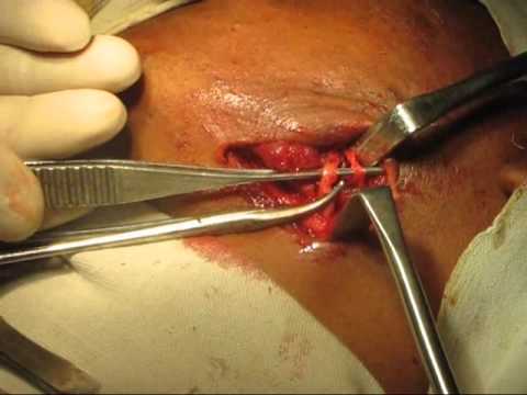 how to treat a zygomatic fracture