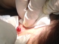 Original Full Length Cyst Video (Very Hard To Watch).MP4