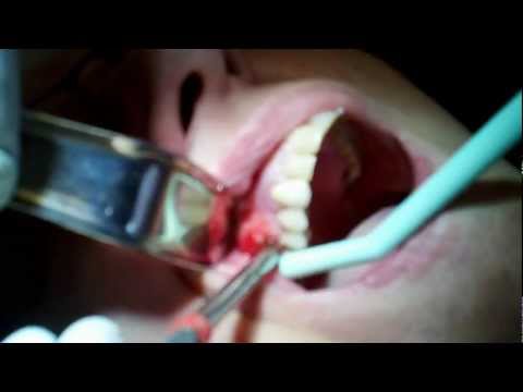 how to drain tooth abscess