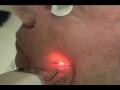 Re:pair Fraxel Laser Re:pair Fraxel Laser