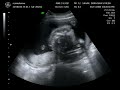Babbo 4D (20w5d)