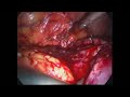 Nefrectomia parziale laparoscopica ASL9 Urologia Grosseto