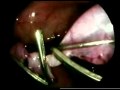 Orquiectomia laparoscópica en criptorquidea abdominal