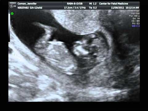 how to measure nt in ultrasound