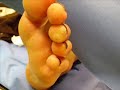 Warts