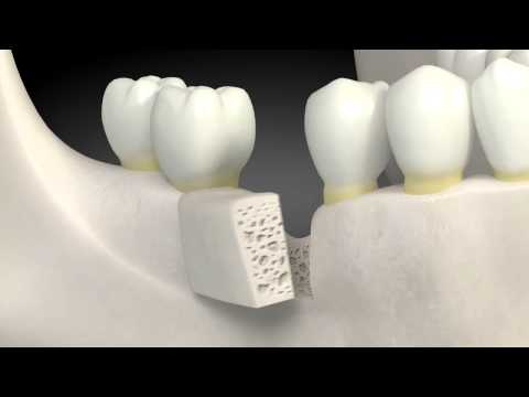 how to harvest iliac bone graft