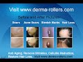 Remove wrinkles, stretch marks and scars with a Derma Roller