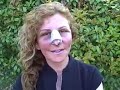 dallas-revision-rhinoplasty-fat-grafting-video-diary-.html