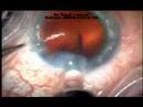 ReZoom AMO Multifocal NXG1 IOL ReZoom AMO Multifocal NXG1 IOL
