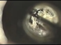 ear wax remoaval part 3