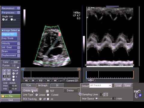 how to measure fetal heart rate in m-mode