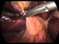 Polyp of the Gallbladder and Hepatitis- Laparoscopic Cholecystectomy and Liver Biopsy