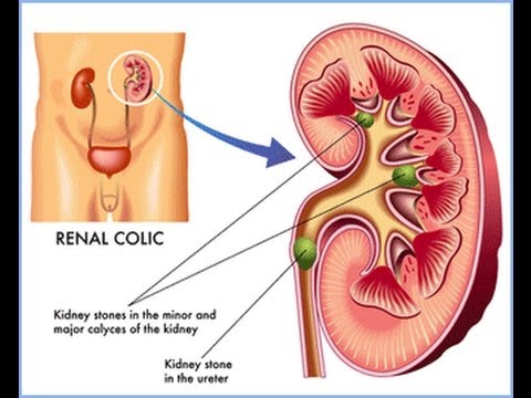 how to dissolve large kidney stones