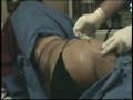 Wide Awake Lipo