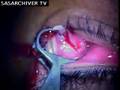 Human Bot-Fly removed from eyelid
